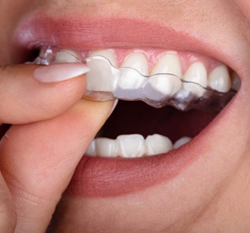 close up of person putting aligner in their mouth 