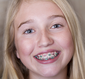 Preteen girl with braces