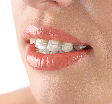 Closeup of smile with braces