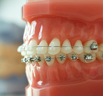 Model teeth with ceramic braces