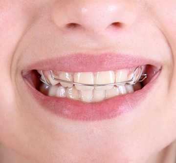 An up-close image of a young child’s teeth while wearing a top retainer