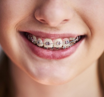 Closeup of a young girl wearing traditional metal braces in Randolph