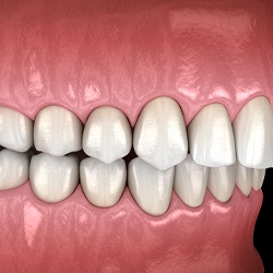 Closeup diagram of an overbite in Randolph before braces