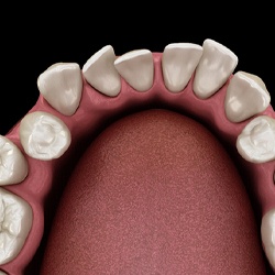 Diagram of crooked teeth in Randolph before braces