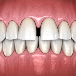 Diagram of gaps between teeth in Randolph before braces