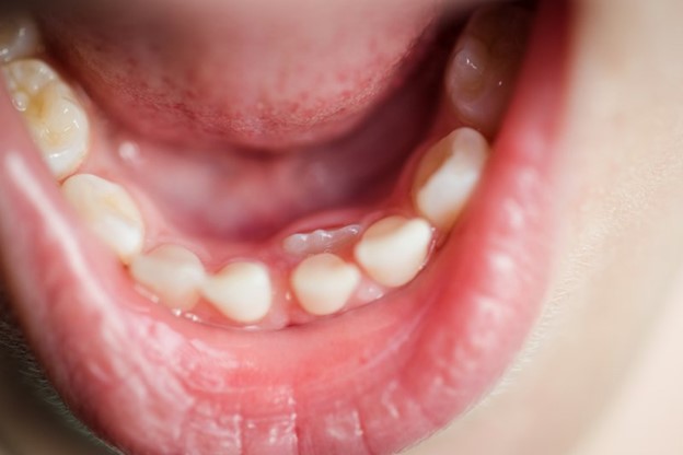 Closeup of child's mouth with baby and adult teeth