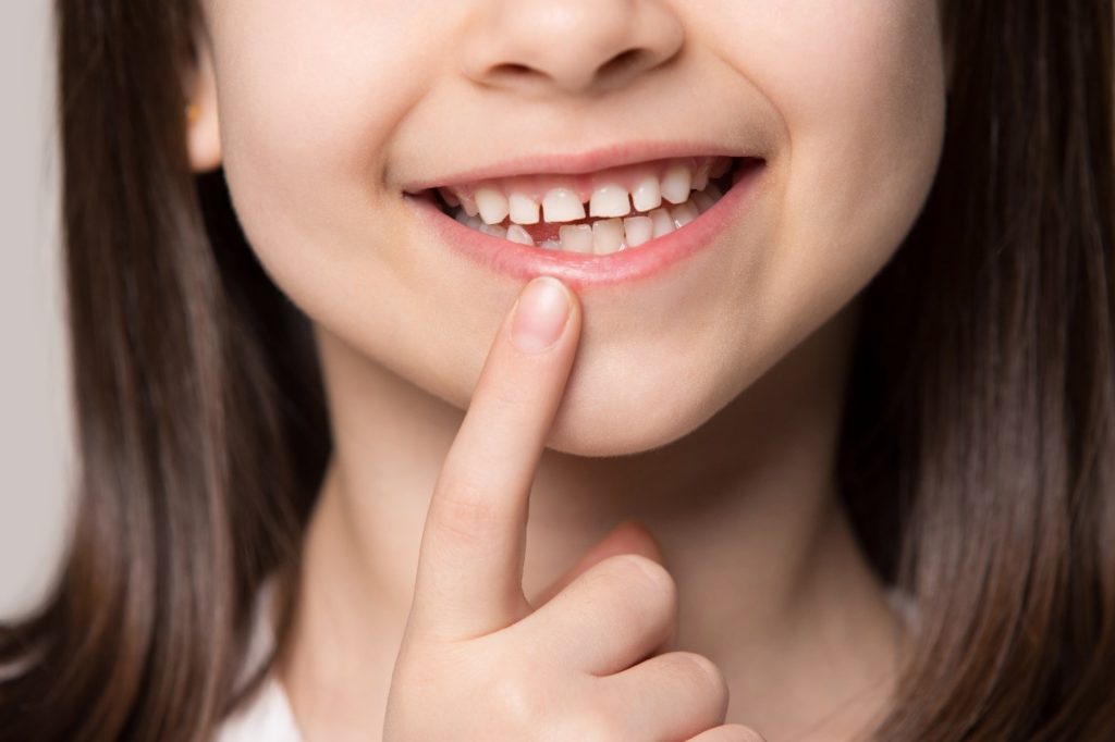 Closeup of young girl pointing to gap in her smile