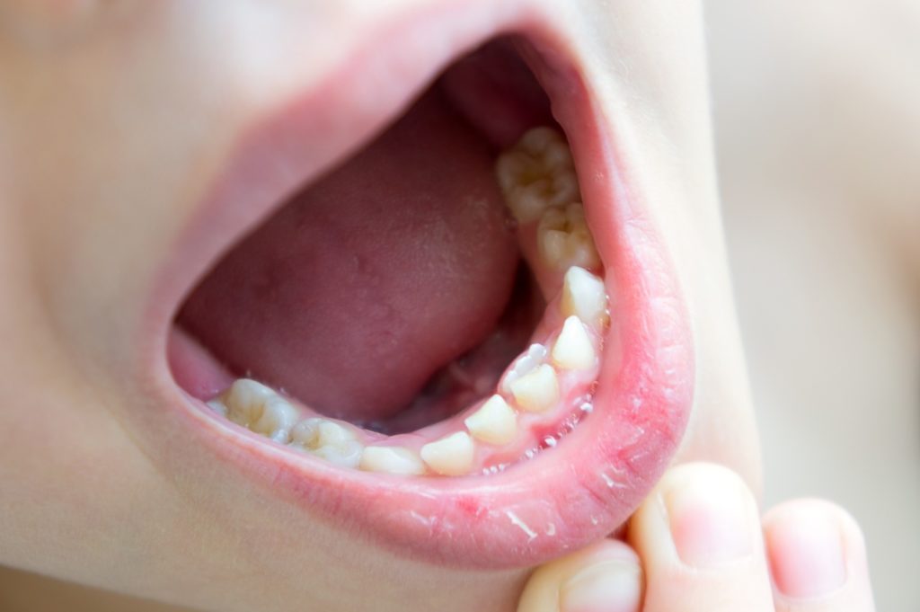 Kid opening his mouth to show shark teeth